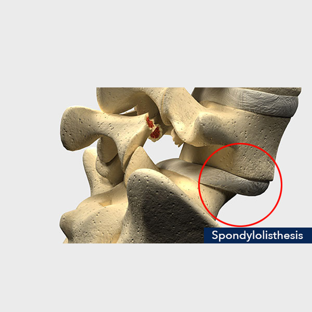 Spondylolisthesis